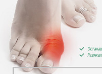 Исправление Косточки большого пальца - Valgus Plus - Игнатовка